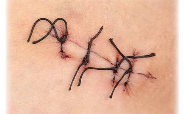 Pourquoi rêver de points de suture ?