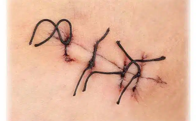Pourquoi rêver de points de suture ?