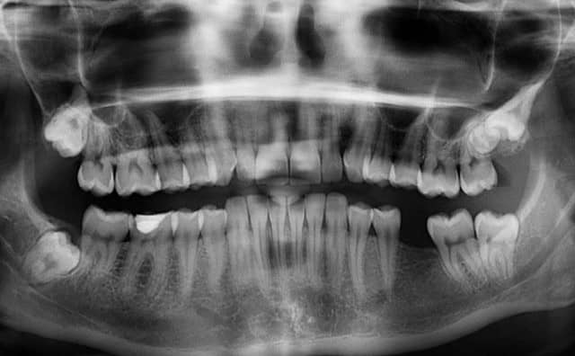 Rêver de dents manquantes dans la bouche : quelles interprétations et significations ?